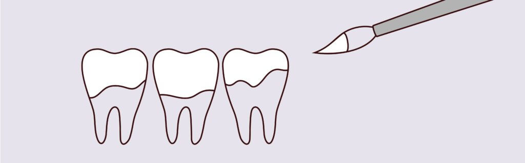 Fluoride Treatments | Holt Dental Care - Dentist in West Jordan - Dr. Joshua C. Holt