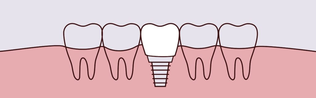 Dental Implants | Holt Dental Care - Dentist in West Jordan - Dr. Joshua C. Holt