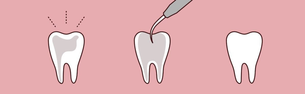 root canal therapy root canals dentist in West Jordan