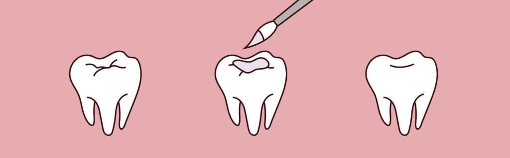 Dental Sealants | Holt Dental Care - Dentist in West Jordan - Dr. Joshua C. Holt