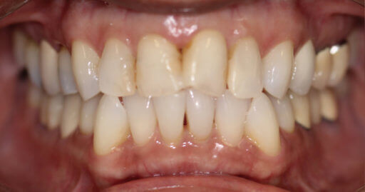 Before And After - Holt Dental Care - Dentist in West Jordan - Dr. Joshua C. Holt