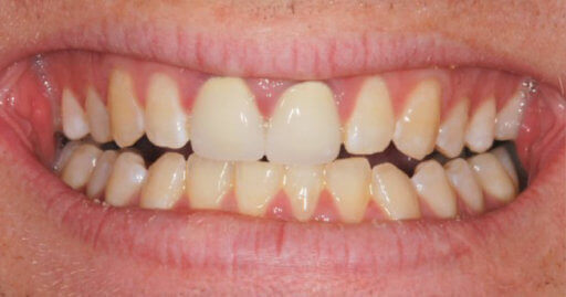 Before And After | Holt Dental Care - Dentist in West Jordan - Dr. Joshua C. Holt
