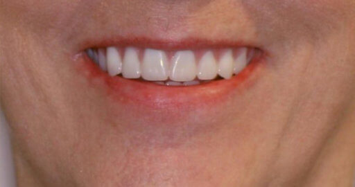 Before And After - Holt Dental Care - Dentist in West Jordan - Dr. Joshua C. Holt