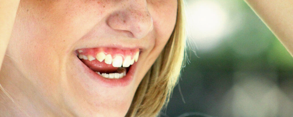 Root Resorption | Holt Dental Care - Dentist in West Jordan - Dr. Joshua C. Holt