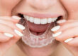 invisalign clear aligners
